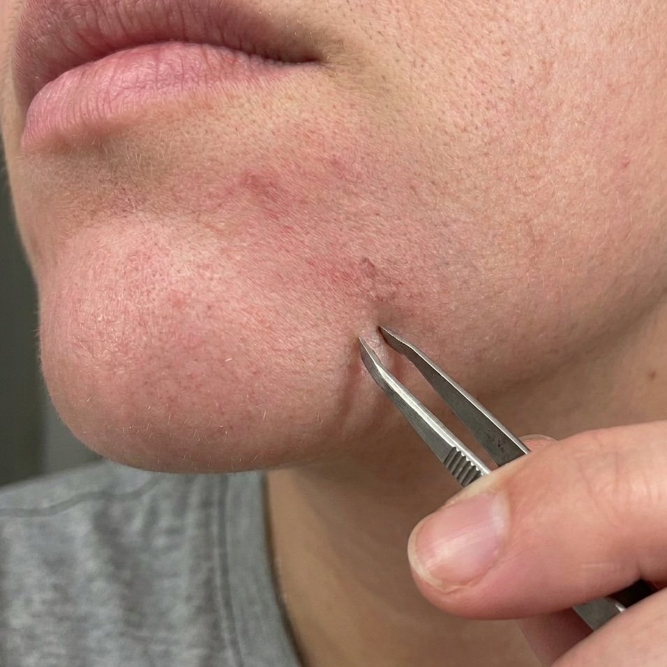 Mentón de Brenda después — con notablemente menos vello facial