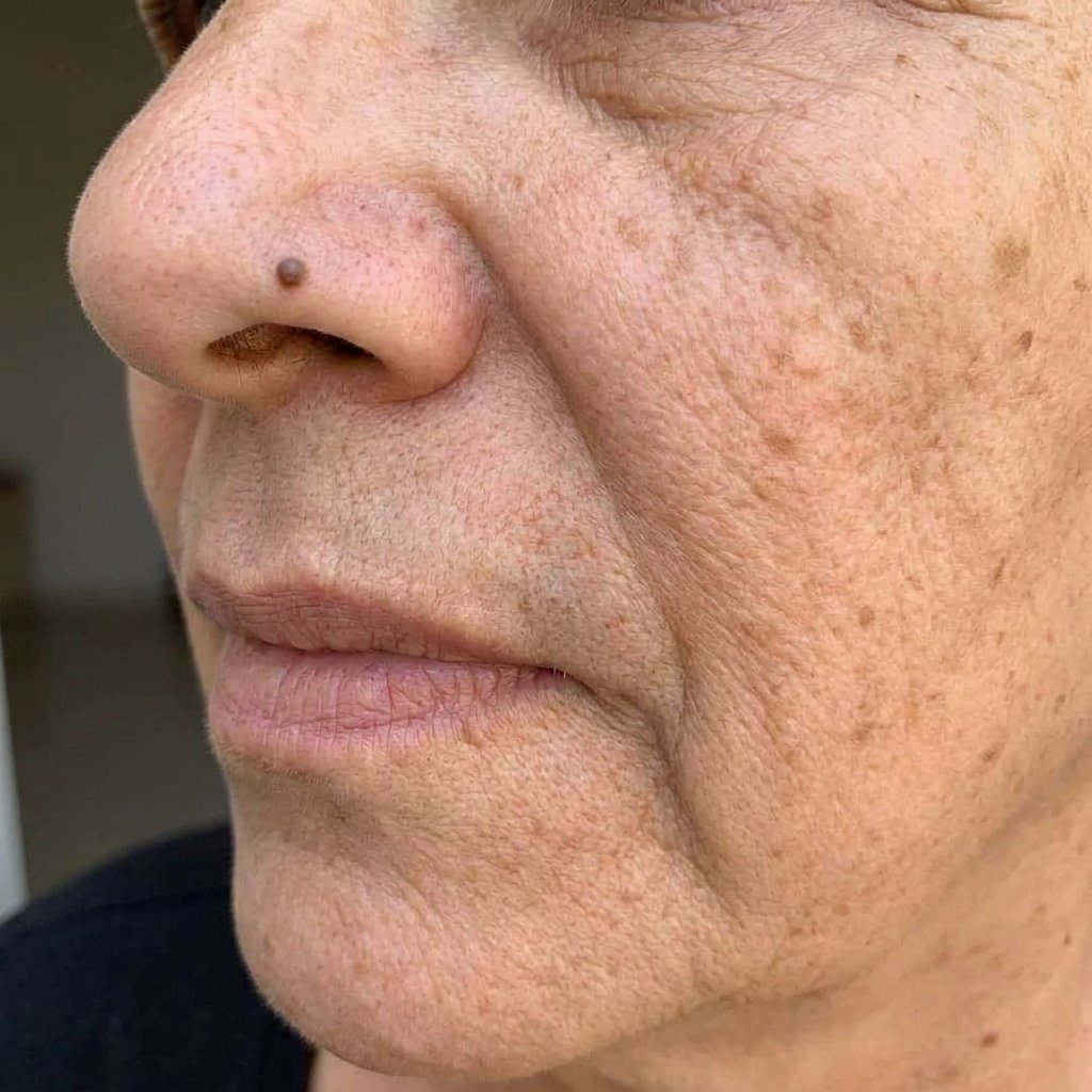 Rostro después — con la piel más limpia